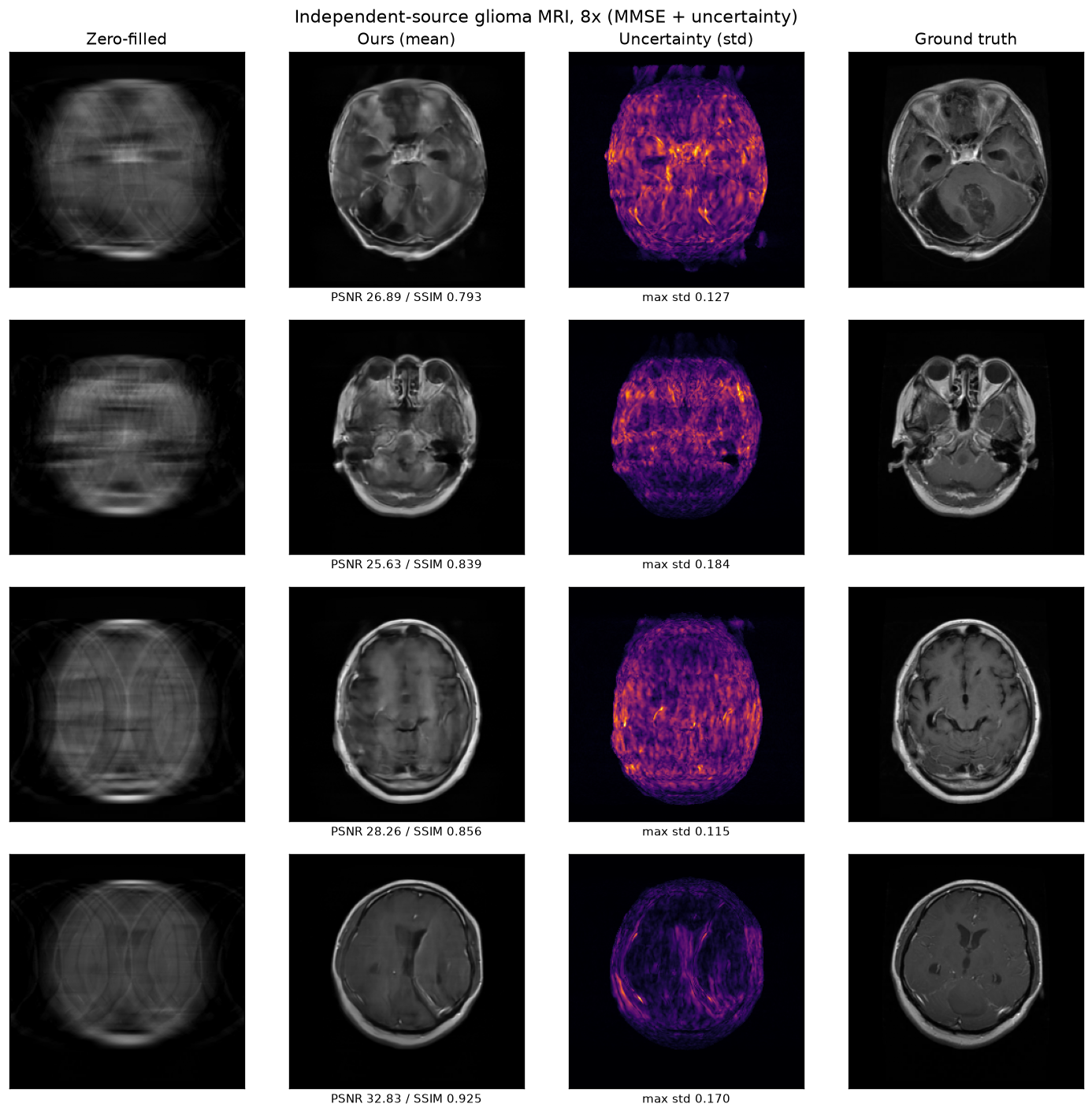 8× reconstruction of a glioma brain scan from an independent hospital source. The skull is visible — absent from the skull-stripped training data — which makes the distribution shift obvious; the reconstruction and its uncertainty map are both visibly degraded versus the in-distribution case.